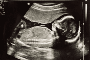 The Difference an Ultrasound Makes